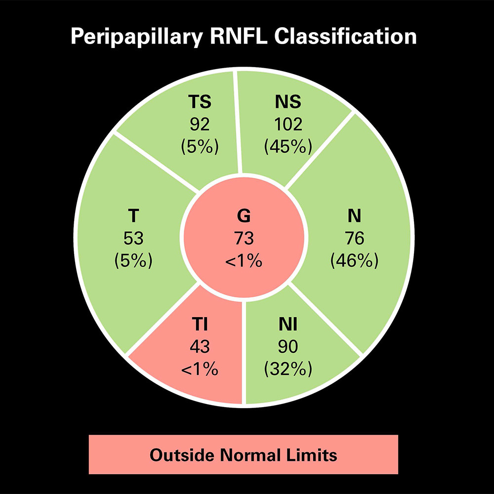 Module Glaucome De L OCT Spectralis Examen Par OCT